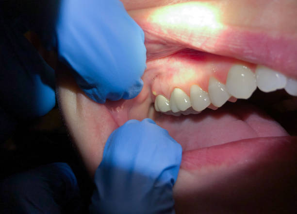 Best Knocked-Out Tooth (Avulsed Tooth) Treatment in Shelton, WA
